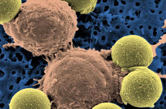 Cancer tratat cu ajutorul virusului HIV