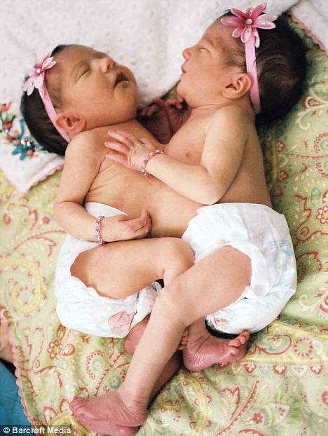 CAZ RAR: Două fetiţe siameze care împart acelaşi ficat s-au născut la Piteşti. Micuţele sunt în stare gravă | VIDEO