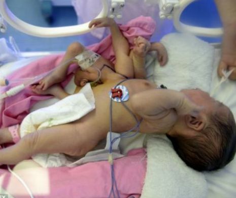 Bebeluşul din China care s-a născut cu patru mâini şi patru picioare a fost operat| FOTO