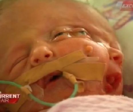 Un bebluş s-a născut cu două feţe. Medicii au fost şocaţi FOTO VIDEO