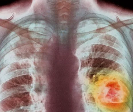 Cancerul pulmonar: simptomele bolii care ucide un român la fiecare 16 minute