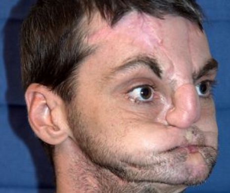 A fost desfigurat de o împuşcătură în cap, însă arată uimitor după reconstrucţia feţei. Acum a pozat într-o revistă pentru băprbaţi | FOTO VIDEO