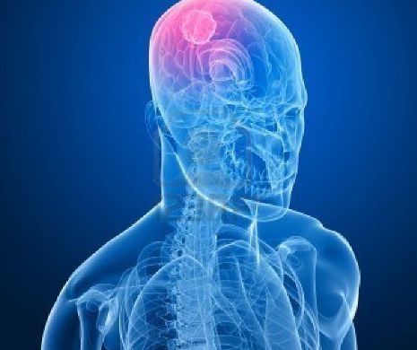 Tot mai multe cazuri de cancer la creier în rândul tinerilor. Când e durerea de cap,un semn de alarmă?