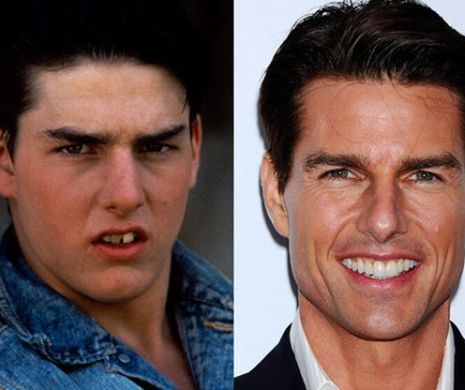 Ce face o DANTURĂ frumoasă pentru celebritate: 10 STARURI înainte şi după ce şi-au aranjat dinţii | GALERIE FOTO