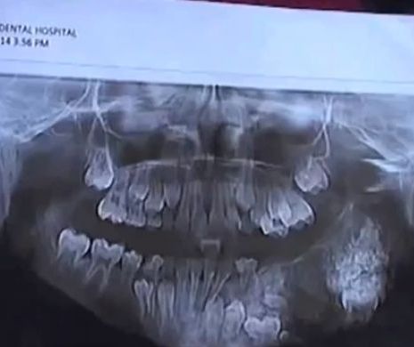 Un caz EXTREM DE RAR. Unui copil i-au fost scoși 80 de dinți din maxilar. ATENȚIE, IMAGINI ȘOCANTE!