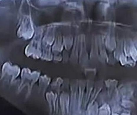 Unui copil de 7 ani i s-au scos 80 de dinți.VIDEO
