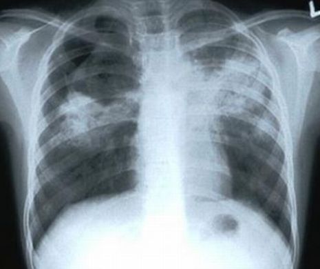 Tuberculoza atacă săracii și romii