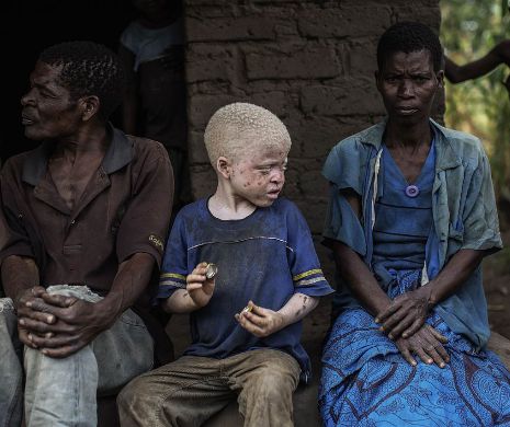 Drama albinioşilor victime ale vrăjitorilor care plătesc sume fabuloase pentru "un set complet de membre" ale unei persoane cu albinism FOTO şi VIDEO