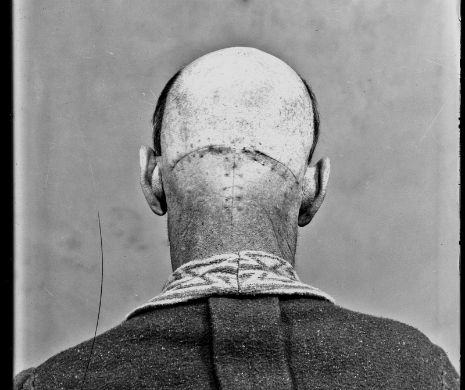 Imagini şocante: primii oameni operaţi pe creier GALERIE FOTO
