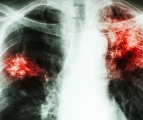 Revoltător. Tuberculoza nu poate fi depistată la timp în România, pentru că medicii nu ştiu să folosească aparatele moderne de MILIOANE de euro