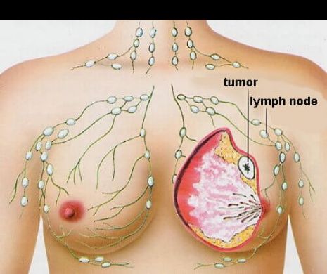 Cinci tipuri de cancer care apar cel mai des la femei