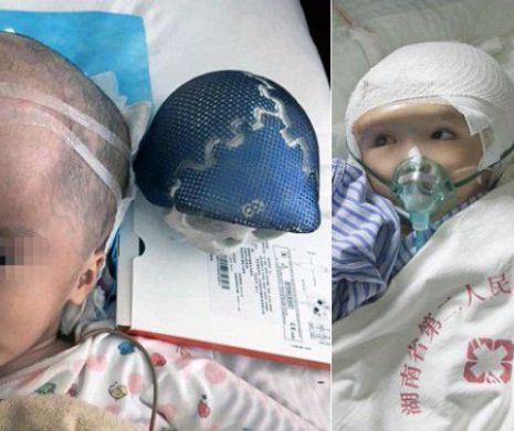 Ea este fetița care a beneficiat de prima operație de reconstrucție a craniului prin imprimare 3D