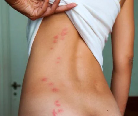 5 lucruri care te fac un magnet pentru țânțari