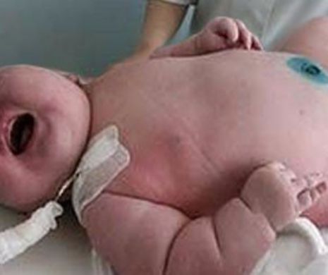 O femeie cu OBEZITATE MORBIDĂ a nascut un bebeluș URIAȘ de 16 kilograme