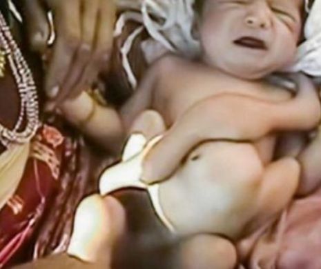 VIDEO Un bebeluş s-a născut cu OPT PICIOARE. Povestea incredibilă a micuţului care şi-a pierdut geamănul în pântec