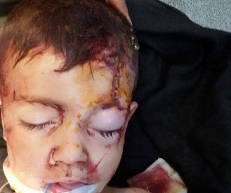 Dovada TERIFIANTĂ că ruşii bombardează civili în Siria. Unui copil de 3 ANI i-a rămas o bucată de BOMBĂ înfiptă în craniu. IMAGINI DEVASTATOARE | GALERIE FOTO ŞI VIDEO