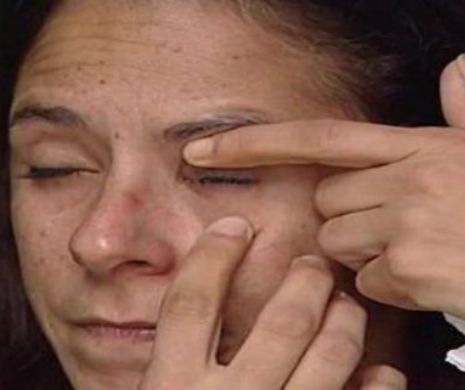 Greşeală TERIBILĂ: O femeie s-a DESFIGURAT după ce a încurcat picăturile de ochi cu Super Glue | Galerie Foto