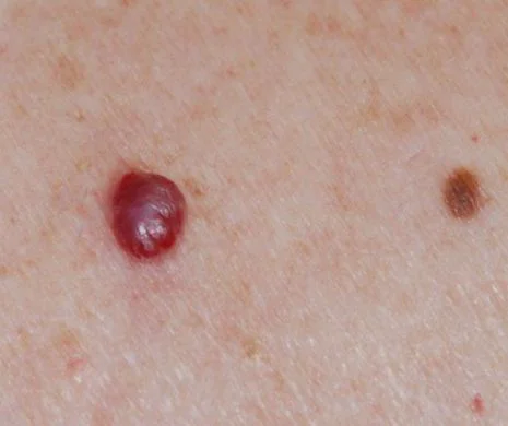 Semnele care prevestesc cancerul se văd pe piele. Când este cazul să mergem la medic?