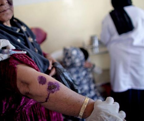 Boala ”MÂNCĂTOARE de CARNE” face ravagii în Siria. Cercetătorii cred că mulţi dintre REFUGIAŢI sunt infectaţi