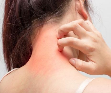 Care este tratamentul corect pentru dermatita de contact