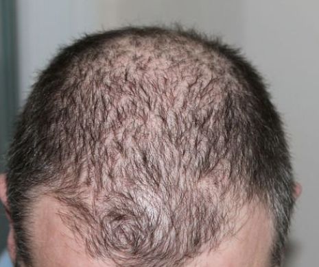 Tratament homeopat pentru a stopa căderea părului