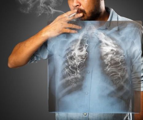 În 9 din 10 cazuri de cancer pulmonar, de vină e fumatul