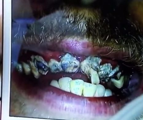 Un tânăr de 21 de ani NU s-a spălat pe dinți NICIODATĂ! Ce i-au descoperit medicii în gură este INCREDIBIL - VIDEO EXPLICIT