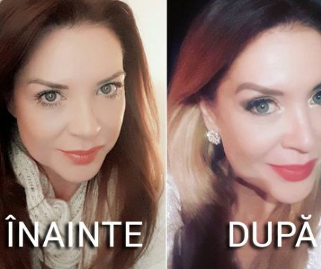 Liftingul facial cu fire – Chirurgie estetică Dr. Oana Vlăsceanu