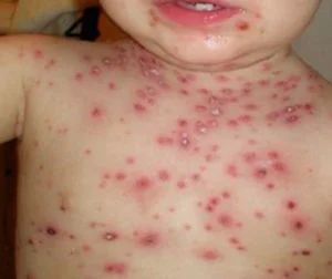 Alertă sanitară în Satu Mare. Focar de hepatită A, 642 cazuri de rujeolă, boala legionarilor