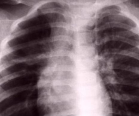 În fiecare oră, un român moare de cancer pulmonar