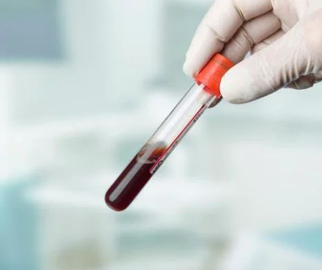 Dacă vezi că urina a devenit roz, roșie sau maro,  trebuie neapărat să mergi la un medic