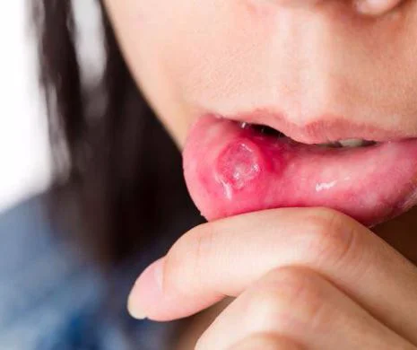Poate apărea oriunde în gură, inclusiv pe interiorul obrajilor, pe limbă, buze sau pe cerul gurii și se tratează cu un remediu