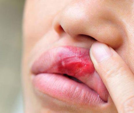 Cancerul cavitatii orale: simptomele de debut trec neobservate