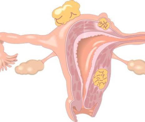Ce sunt polipii uterini. Majoritatea femeilor SUFERA DE ASTA! Daca menstruatia ta tine mai mult de...