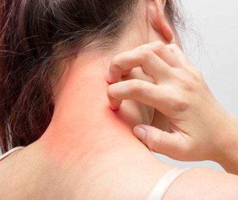 Cum scapi de bolile pielii cu tratamente naturale