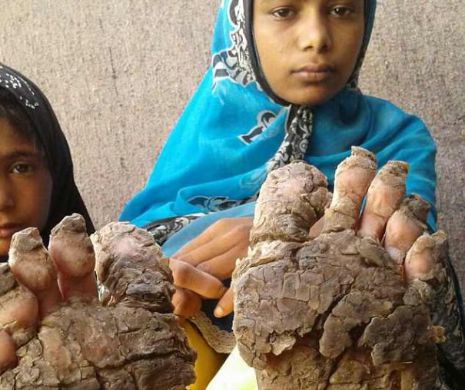 Drama copiilor cu picioare de piatră. Incredibil ce se întâmplă cu pielea lor. Nu pot fi SALVAȚI!