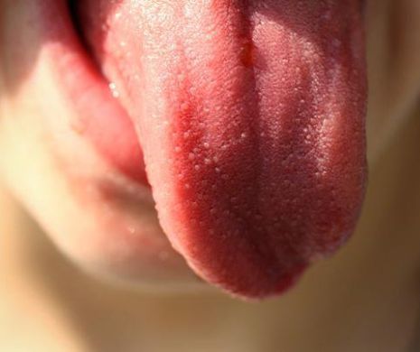 Cancerul limbii- Simptome si tratament