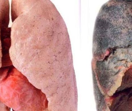 Povestea primului transplant pulmonar
