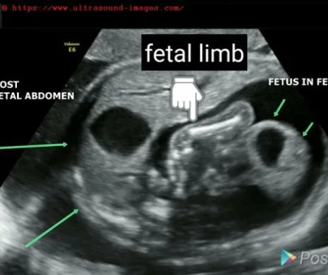 Caz şocant! Fetus in fetu: Un făt s-a format în pântecele gemenei. Foto în articol