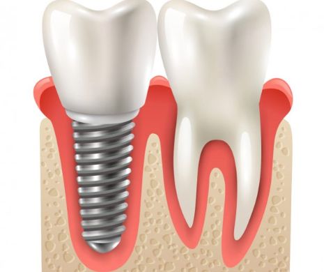 Ce trebuie să știi atunci când vrei să faci un implant dentar?