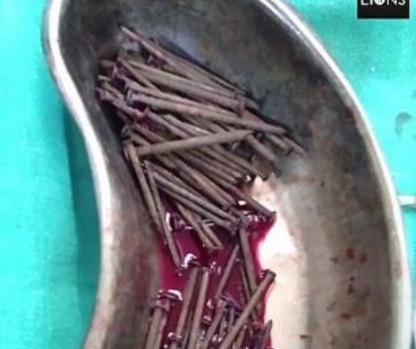 Imagini şocante în articol cu stomacul unui bărbat care a înghiţit peste 116 cuie şi alte metale