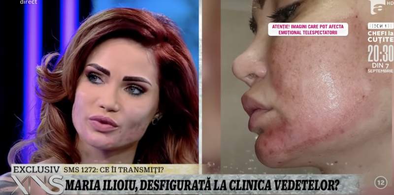 O vedetă din România a fost desfigurată după ce a făcut un tratament cosmetic