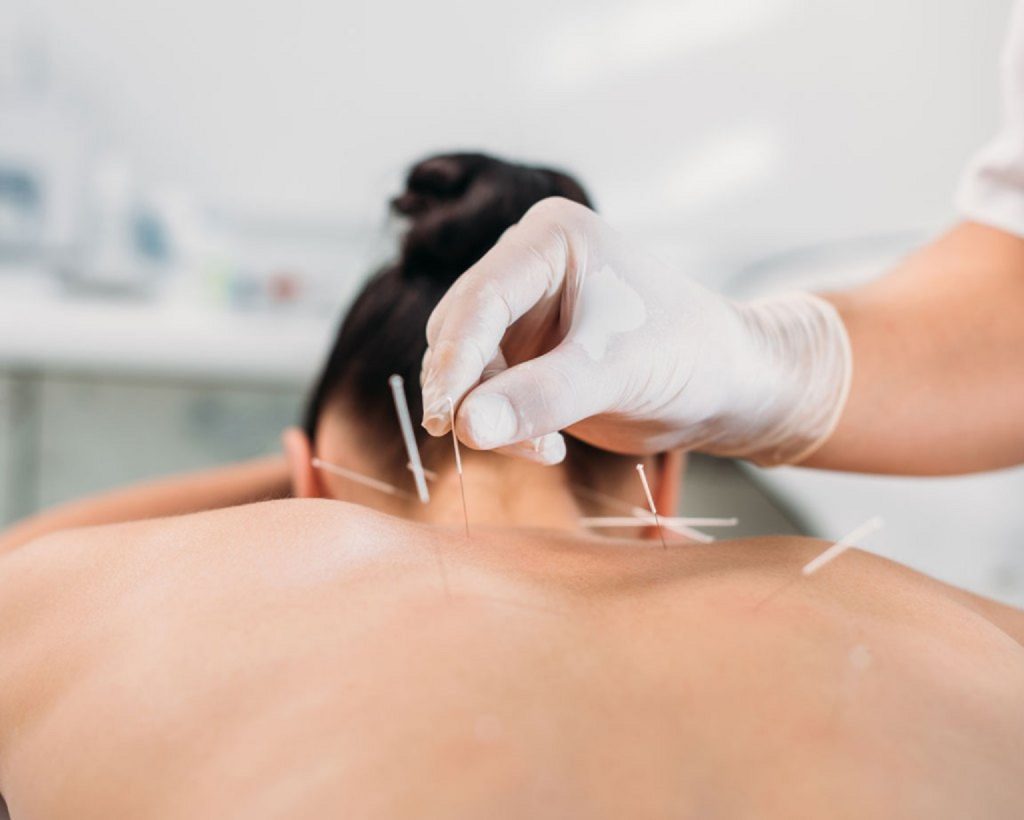 Este eficient un tratament acupunctură pentru ameliorarea durerilor de spate?