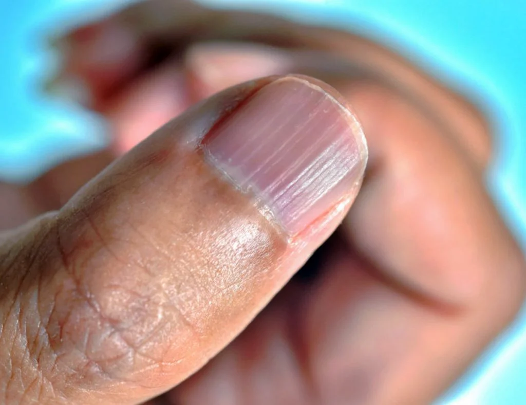 Semnele importante ale unor boli grave pot fi văzute prima dată pe unghii
