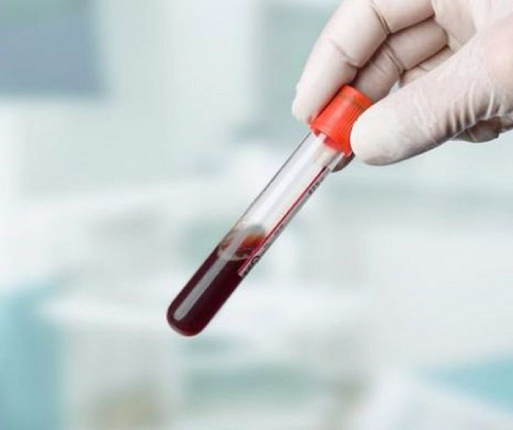 Șansă la viață: un test de sânge inovator poate detecta 50 de tipuri de cancer