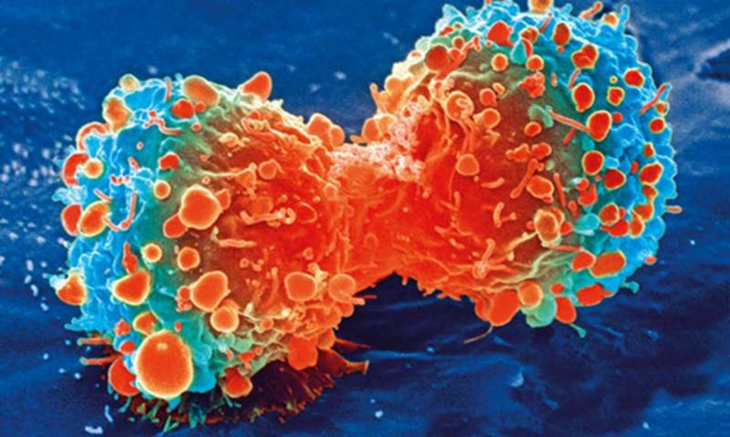 Descoperire majoră în lupta împotriva cancerului. Savanții italieni au identificat molecula care face tumorile mai agresive