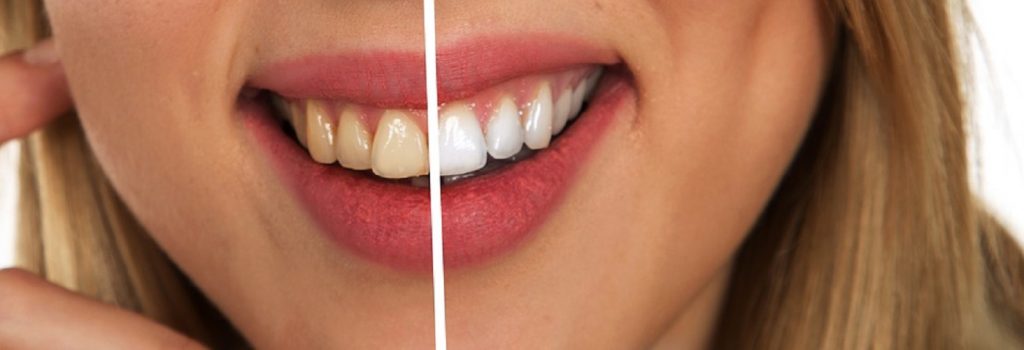 Cele mai periculoase trucuri de albire a dinților acasă