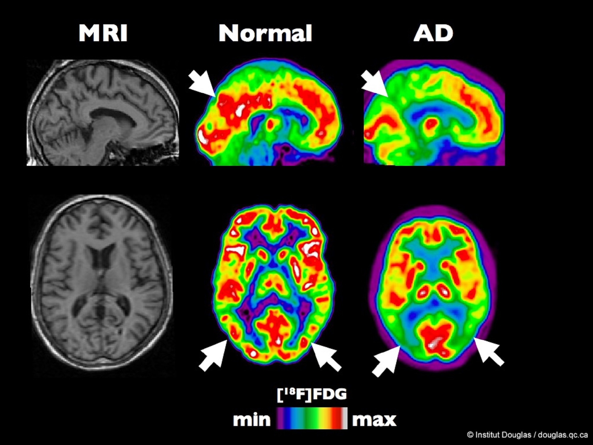 105 brain. Позитронно-эмиссионная томография головного мозга. Позитронно-эмиссионная томография мозга (ПЭТ). ПЭТ кт при Альцгеймера. ПЭТ кт головного мозга.