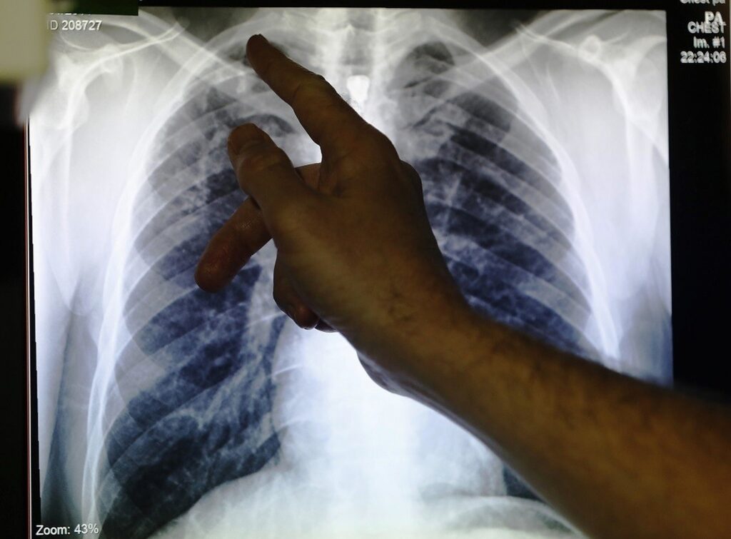 Cazurile de tuberculoză se înmulțesc în România, pe lângă cele de gripă și flurona. La ce fel de simptome trebuie să fim atenți