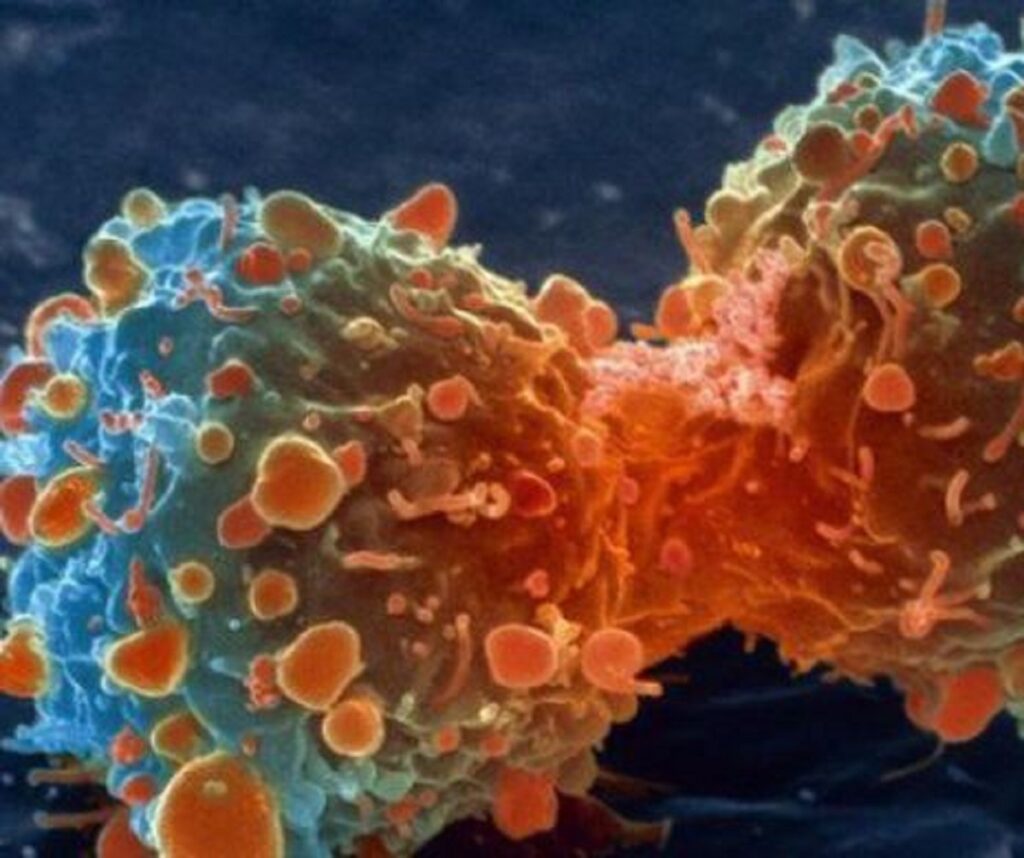 Oamenii de știință au descoperit de ce se îmbolnăvesc oamenii de cancer pulmonar